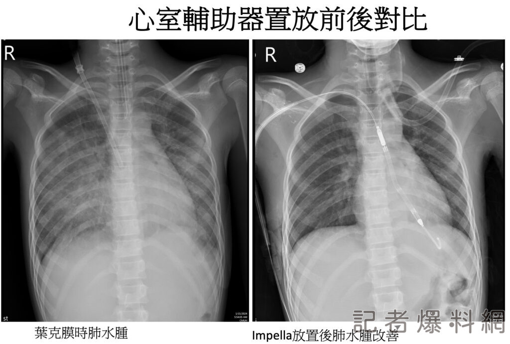 13歲少女胸悶呼吸困難突發猛爆性心肌炎  「微型心臟幫浦」急救續命