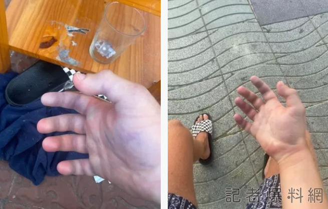 出國旅遊被毒蜘蛛咬！19歲英男到西班牙伊比薩島度假　遭咬「手指全黑慘截肢」