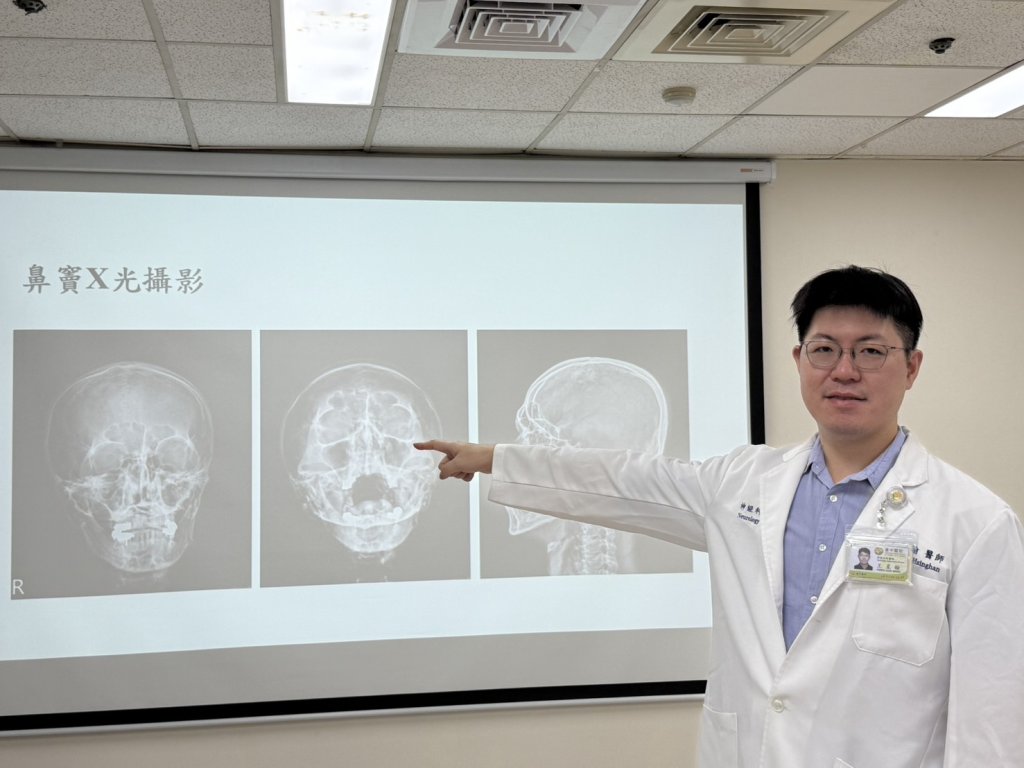 頭痛三個月吃止痛藥沒效 原來是鼻竇炎惹禍