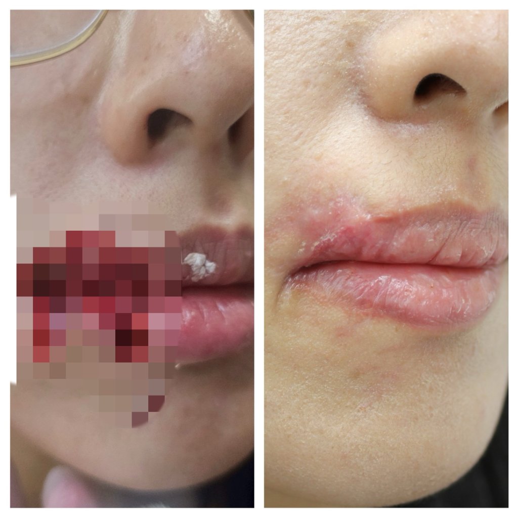 台中28歲妙齡女被愛犬咬掉嘴邊肉! 黃金6小時PRP增生療法修復成功