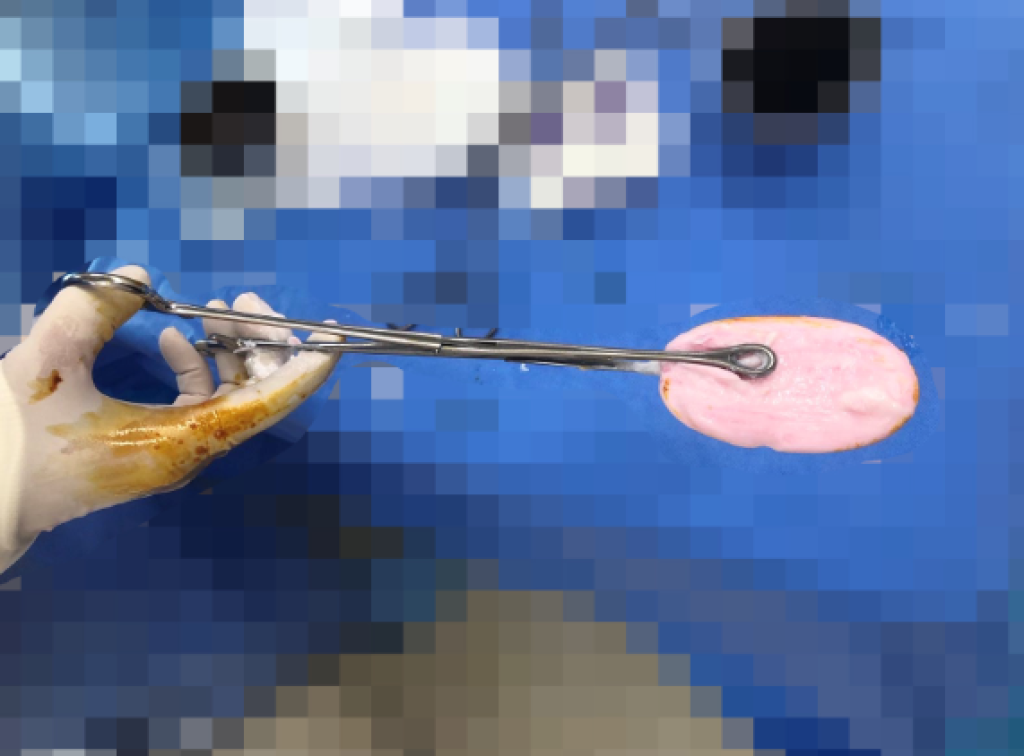 12歲女童洗澡時誤將肥皂塞入下體　身體不適出血緊急送醫取出