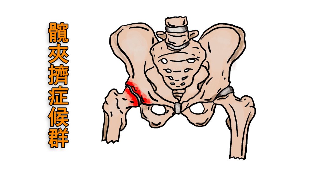 葉姓裝潢師傅數年來飽受下蹲疼痛困擾 竟是羅患了「髖關節夾擊症候群」