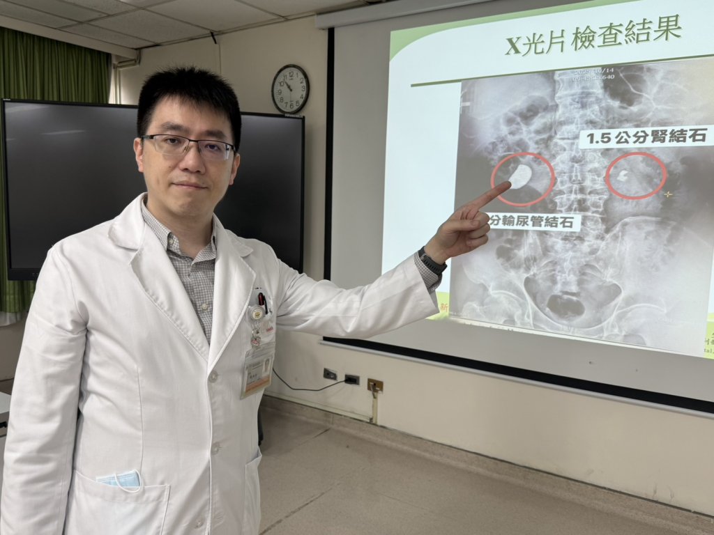 他腰痠血尿就醫 驚!右輸尿與左腎赫見大結石